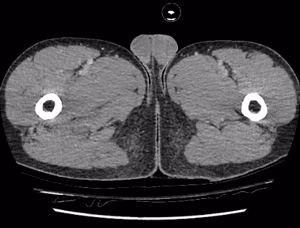 Sample RSNA Abdominal Trauma Dataset