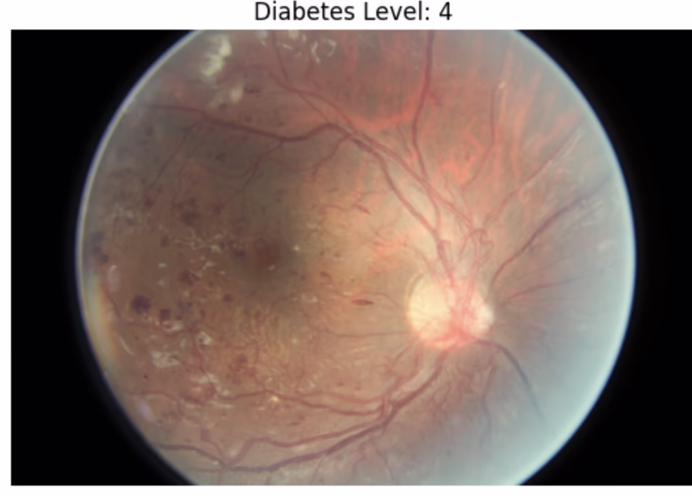 Proliferative DR