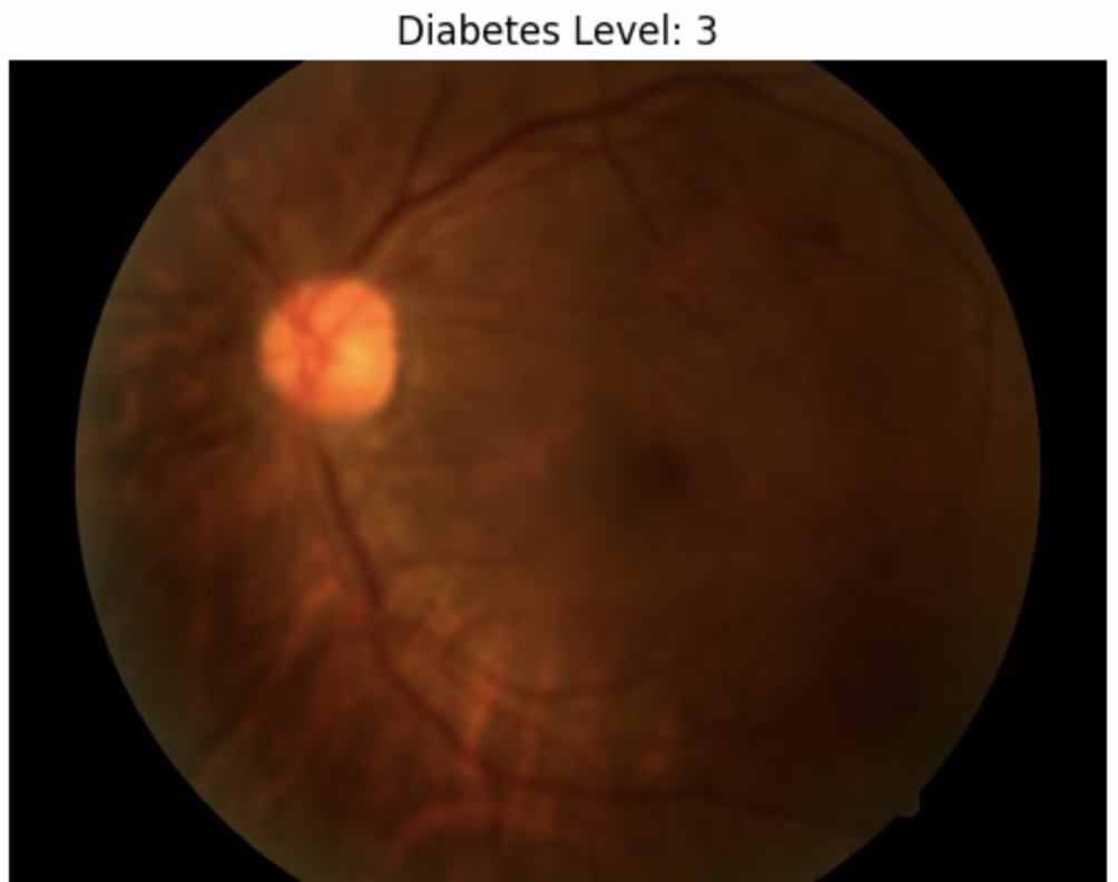 Severe DR